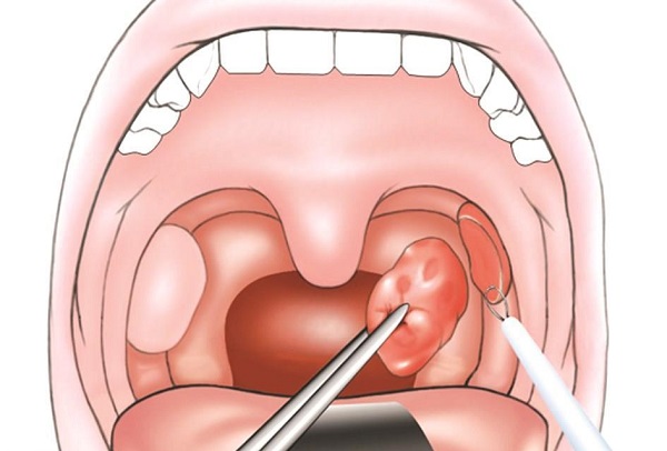 برداشتن لوزه(تانسيلكتومي)